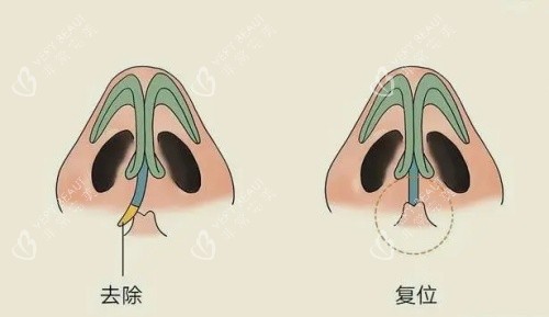 歪鼻修复矫正