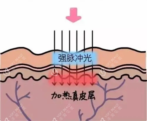 光子嫩肤针对的皮肤层