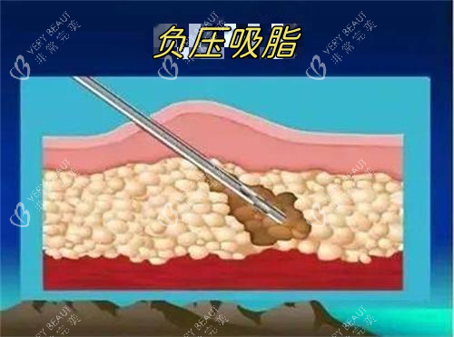 负压吸脂示意图