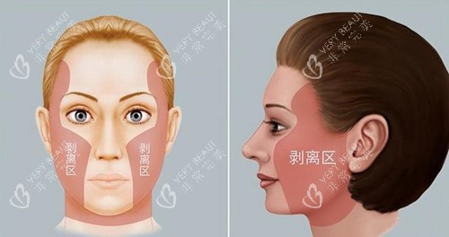 拉皮手术剥离区
