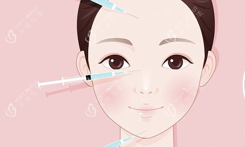 注射美容的部位示意图