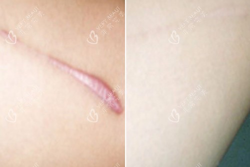增生疤痕修复对比图