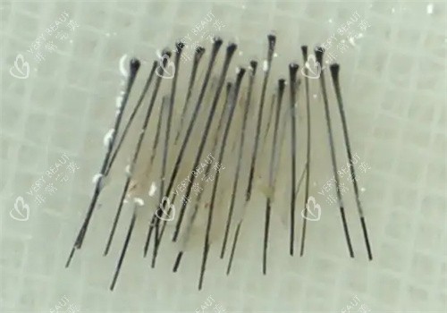 毛囊处理照片