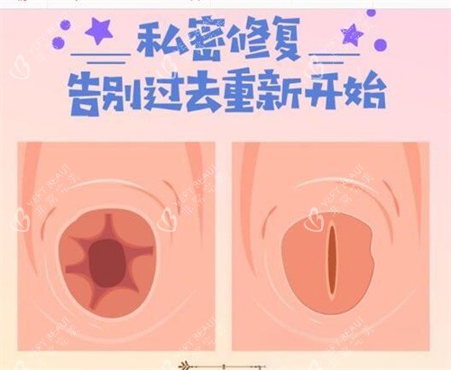 处女膜修复前后对比图