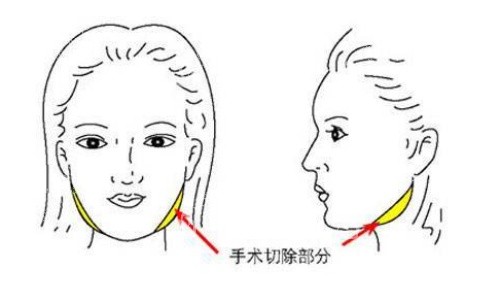 面部磨骨手术示意图