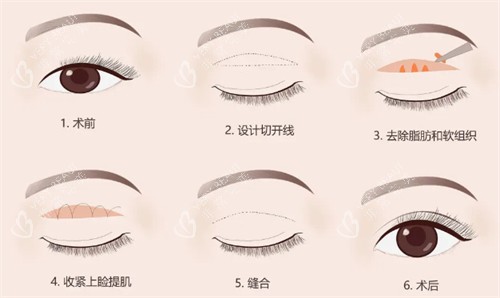 提眉手术步骤分解