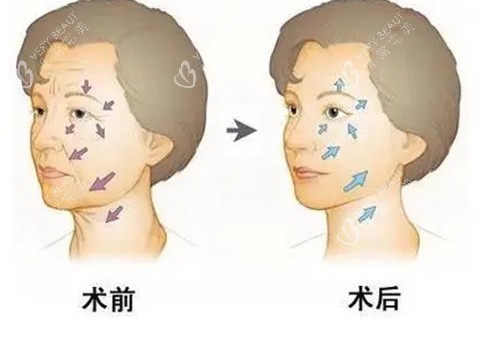 面部抗衰前后对比卡通示意图