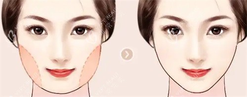 面部吸脂