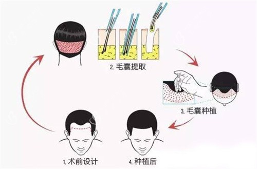 毛囊移植步骤动画图