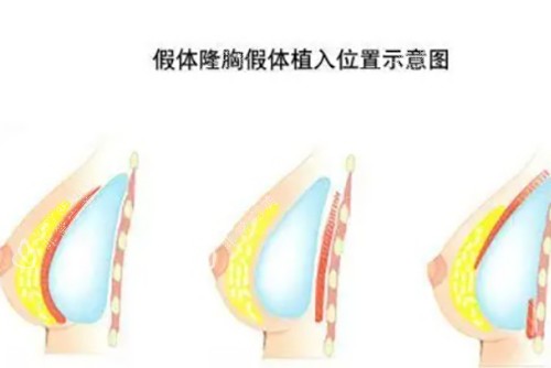 假体隆胸示意图