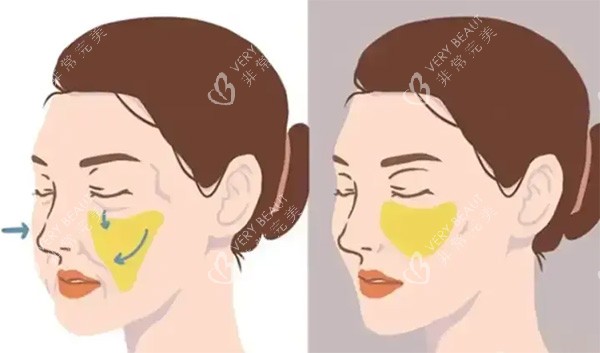 馒化脸脂肪移位照片