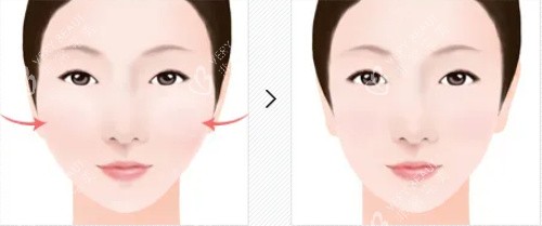 颧骨整形对比图