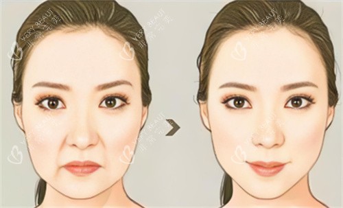 面部抗衰对比