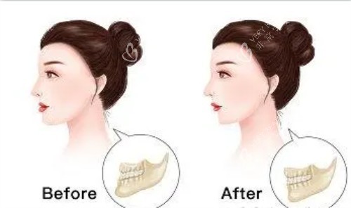 正颌手术后的成效图片
