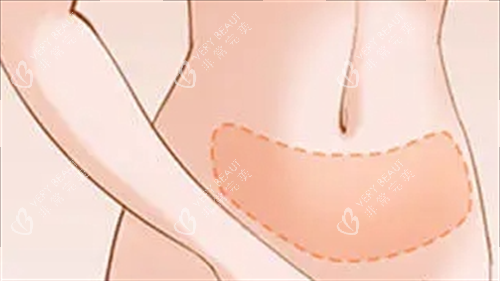 腹部吸脂成效展示图