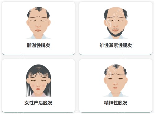 不同脱发类型
