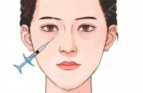 泪沟注射
