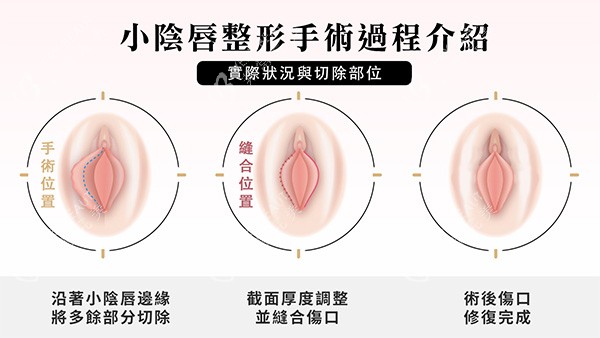 阴唇一边长一边短改善照片