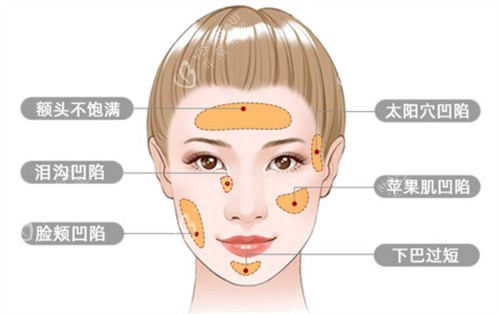 面部脂肪填充适应症