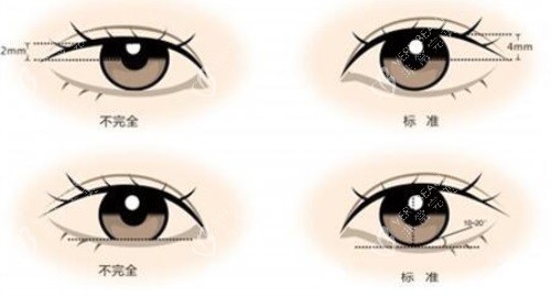 双眼皮示意图