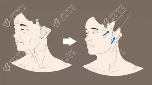 拉皮示意图