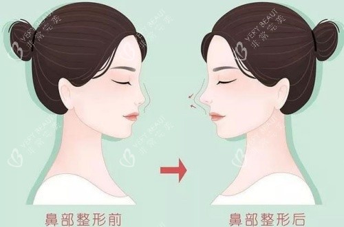 隆鼻术后漫画示意图