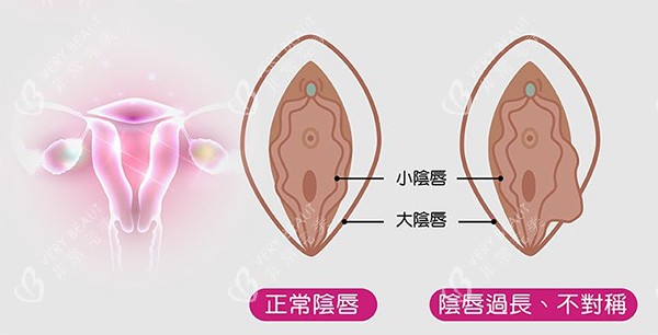 阴唇不对称改善照片