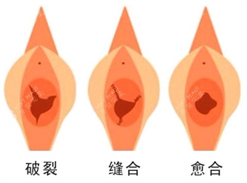 处女膜修复手术前后对比图