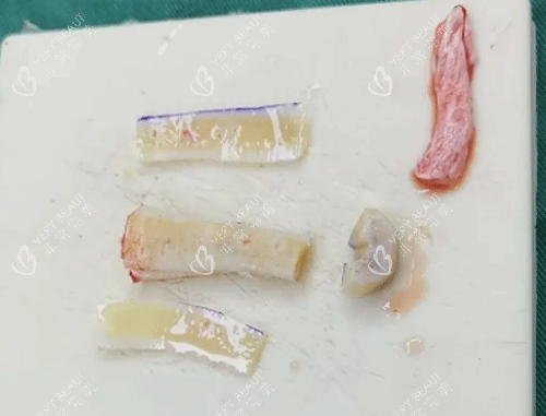 肋骨隆鼻材料