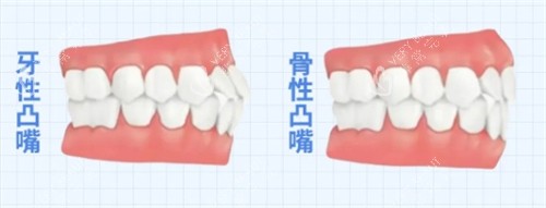 骨性凸嘴和牙性凸嘴