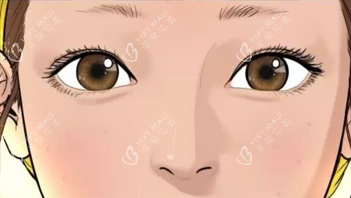 自然双眼皮