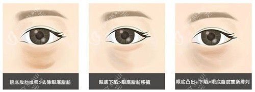 眼底脂肪重排对比
