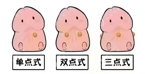 入珠手术动画