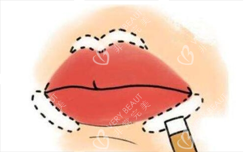 纠结好久的唇部整形，在北京画美马群医生这儿圆梦啦，自然美唇太惊艳！