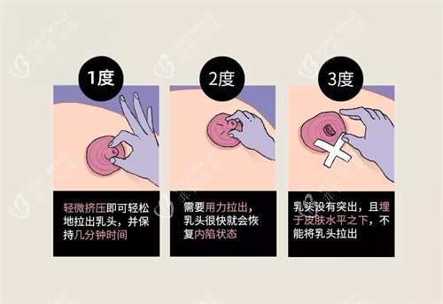 乳头内陷按摩方式图