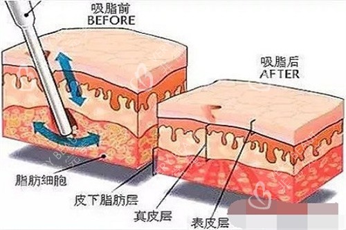 犹豫要不要做吸脂？看我分享王世虎吸脂全过程，从纠结到自信，变化惊人！