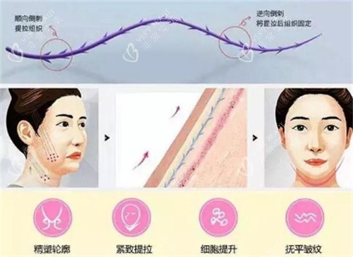 面部埋线提升前后对比图