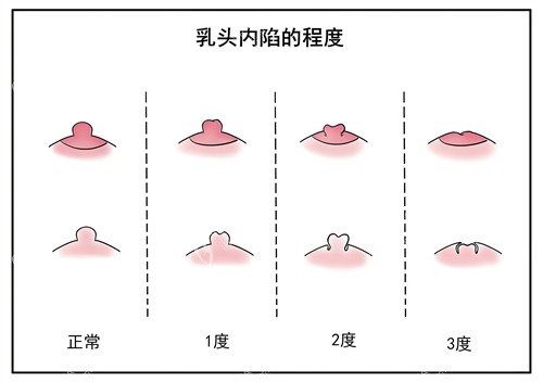 乳头内陷的程度演示图