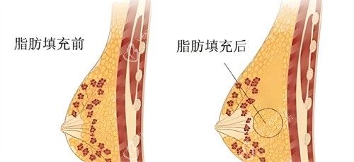 自体脂肪隆胸脂肪对比