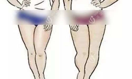 大腿吸脂手术术前肉肉图