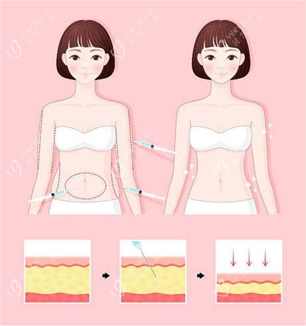 腰腹吸脂对比