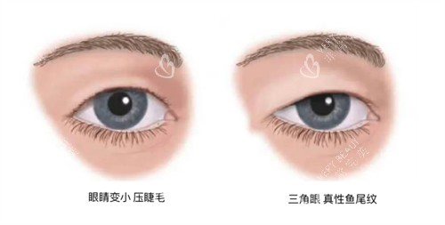 需要提眉的状况