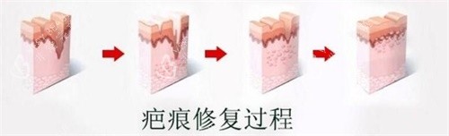 疤痕修复过程图
