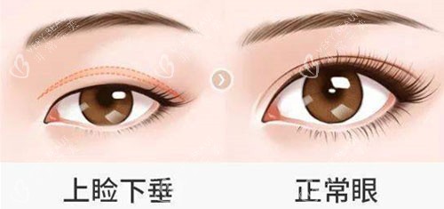 上睑下垂手术