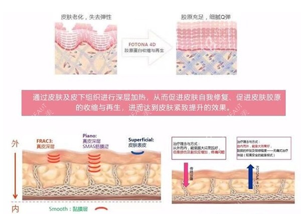 欧洲之星fotona4dpro改善皮肤示意图