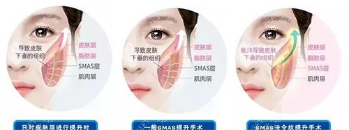 三类拉皮手术方法对比
