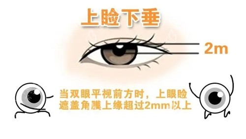 激光祛斑手术原理图