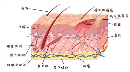 增生疤痕是怎么形成的