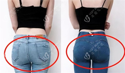 臀部吸脂手术背面对比图
