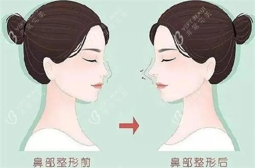 液态隆鼻前后的区别